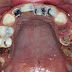 Sâu răng có nên nhổ không?