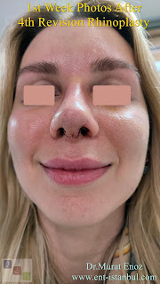 Breathe Implant à Wengen,4. revision nose job, Dent After Rhinoplasty, Complicated 4th Revision Rhinoplasty, Nasal contour irregularities, Postoperative dent issues, Revision rhinoplasty challenges, Rhinoplasty side effects, Nasal structural integrity,