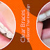 Ceramic Braces are Better Than Invisalign