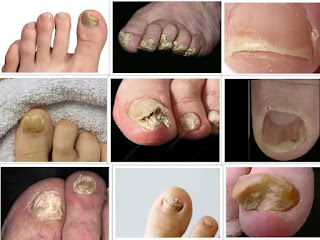 Infections in Toenails how to get rid