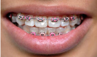 Metal braces come in a variety of colors