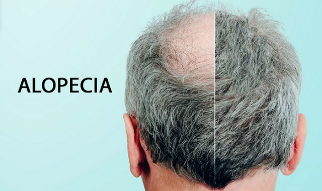 alopecia-hair-fall-reason