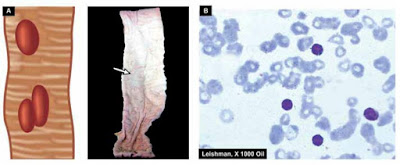 Typhoid fever, Enteric fever, Aasgaduli, Aas_study, Aasstudy, GIT disease, Gastro-intestinal disease 