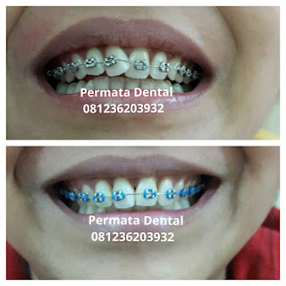 gambar foto behel bracket kawat gigi sebelum dan sesudah perawatan untuk memperbaiki merapikan gigi gingsul gigi miring renggang tonggos berantakan keluar masuk jarang diastema maju mundur tidak rapi tidak beraturan bali denpasar banyuwangi jember tidak rata kocar kacir