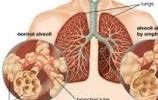 Mengenal, Mengetahui penyebab, gejala, dan cara mengobati radang paru-paru ( pneumonia) | natural