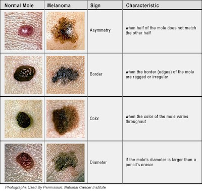 picture of skin cancer image