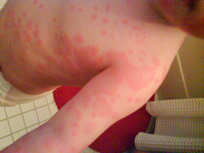 Amoxicillin Allergic Reaction. Allergic Reaction, Fifth