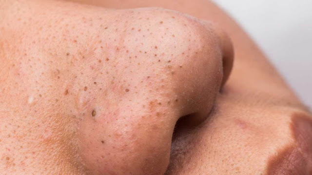 Blackheads causes and treatment