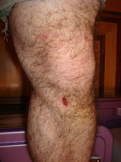 Left Leg and Knee Injury - 2nd Van