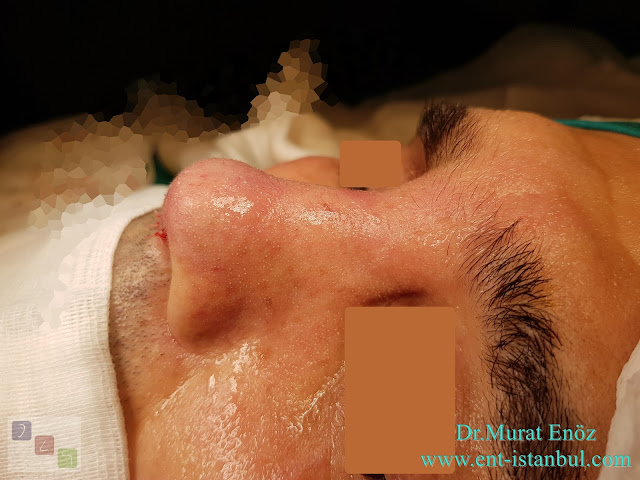 Male Rhinoplasty,Revision Rhinoplasty Operation With Rib Cartilage,Tertiary Revision Nose Aesthetic Surgery,Tertiary Revision Nose Job in Istanbul,