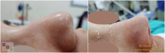 nose tip plasty, alar rim grafts, nasal surgery, tip rhinoplasty, nose reshaping, nasal grafting, cosmetic nose surgery, alar support