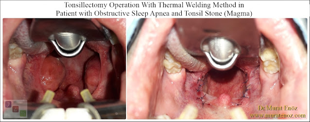 painless tonsillectomy in Istanbul,knifeless tonsil removal,Bloodless tonsillectomy,Thermal welding tonsillectomy,Tonsil removal in Istanbul,Treatment of big tonsils,