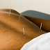 Acupuncture For Back Pain