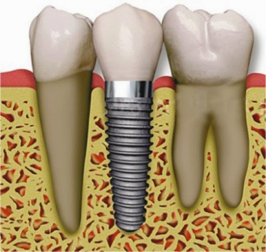 Cheap Dental implants Delhi India