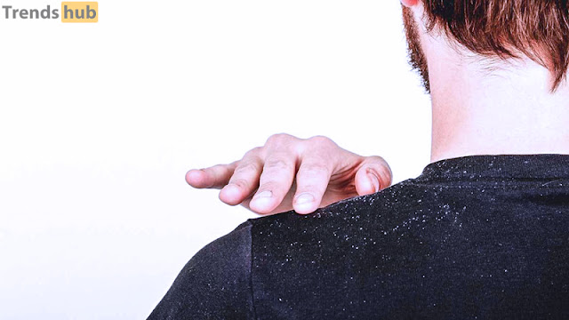 How Long Does it Take to Get Rid of Dandruff?