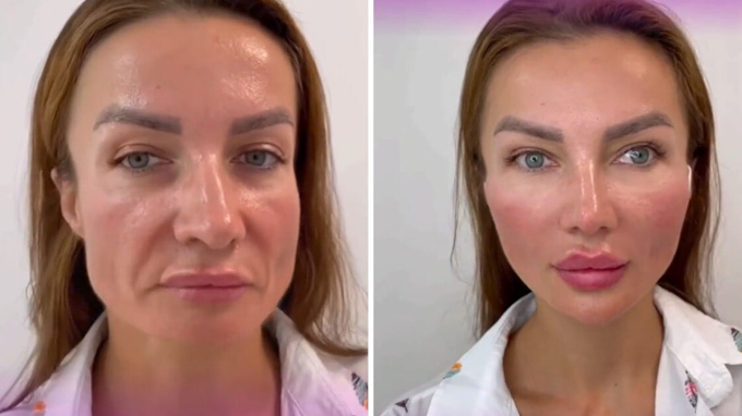  16 people showed their faces after the Full Face rejuvenation procedure, which often causes heated debate online