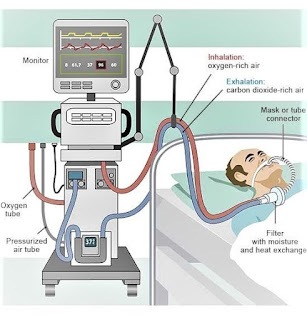 A patient on ventilator