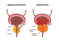 Prostatitis explained