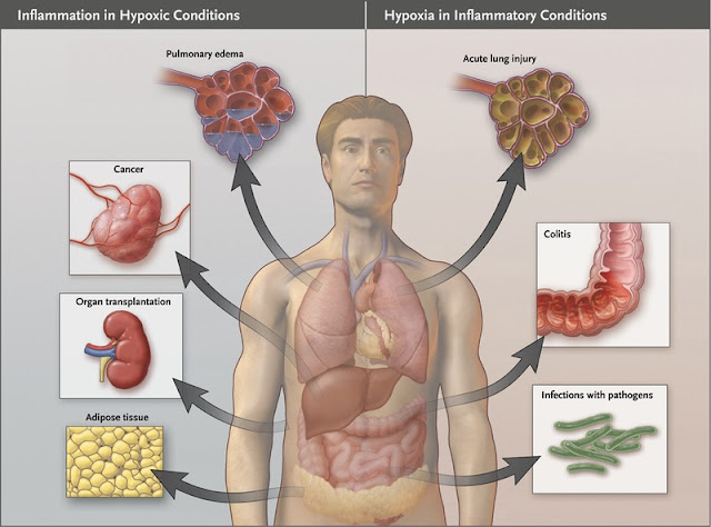 Hypoxia induced inflammation