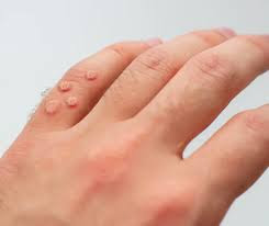 warts