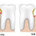 Nguyên nhân gây viêm lợi