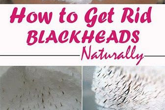 How To Get rid of blackheads naturally