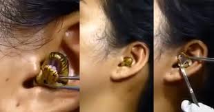 Surgeons struggle to remove live snake from Indian woman's ear