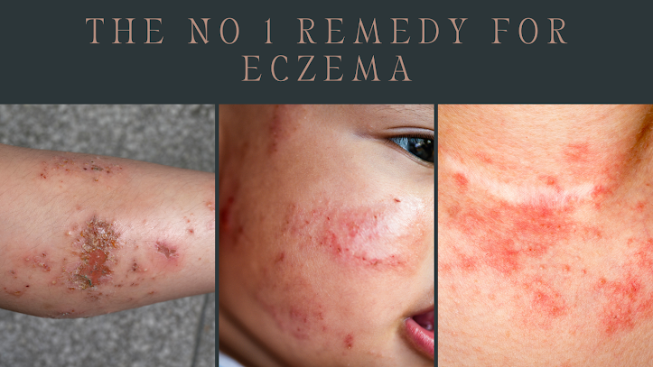 eczema, dyshidrotic eczema, eczema treatment, dyshidrosis, nummular eczema, eczema rash, eczema on face, baby eczema, eczema causes, atopic eczema, eyelid dermatitis