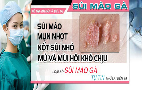 Phòng khám trị bệnh mồng gà ở đâu bình dương