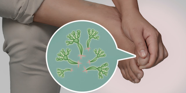 How Do You Get Rid of Fungal Infections?