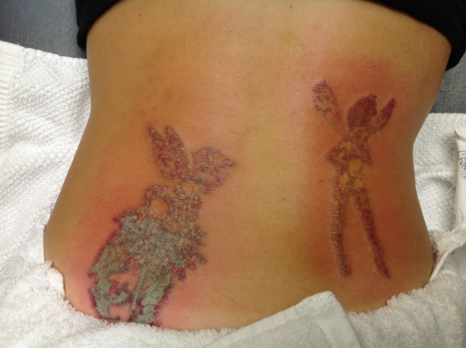 My tattoo removal process: Day 1: My tattoos before and after my first ...