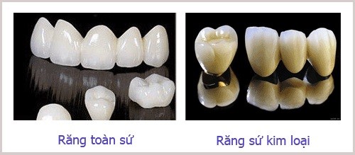 2 dòng răng sứ phổ biến nhất là răng sứ kim loại và răng toàn sứ