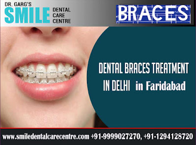 Dental Braces Treatment