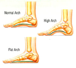 abnormal foot arch previous foot injury tight calf muscles in many ...