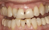 Malocclusion of the Teeth: Causes, Symptoms & Diagnosis