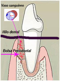<Img src="Esquema-hilo-dental-bacteriemia.jpg" width = "199" height "269" border = "0" alt = "Introducción de patógenos periodontales en la sangre por daño a los vasos por la seda dental">