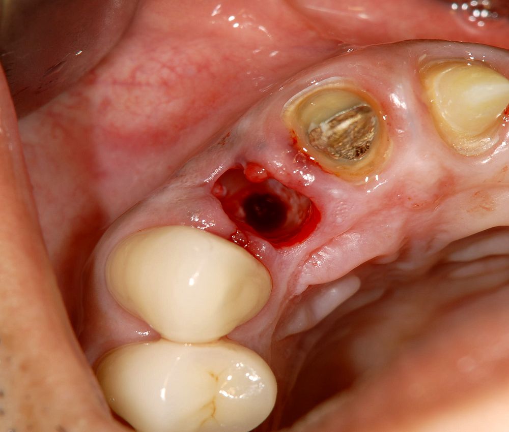 ORAL SURGERY : Infection after tooth extraction