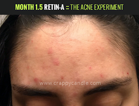 Month 1.5 on Retin-A :: The Acne Experiment