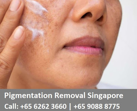 pigmentation removal treatment in Singapore