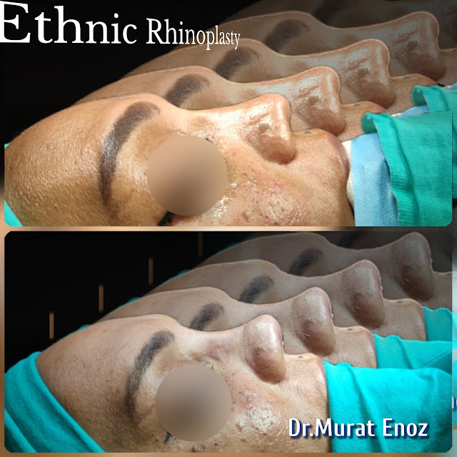 Aesthetic operations for noses with thick skin features, wide and oily skin features