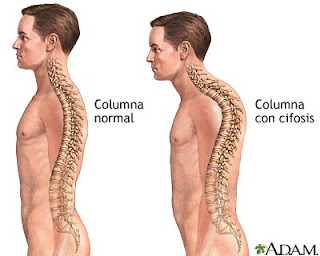 Postura con hipercifosis