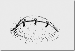 sutura occhio