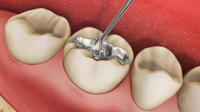 Hiệu quả của trám răng điều trị sâu răng