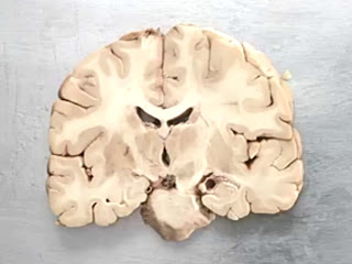 Section of Human Brain