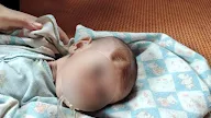 Dianiaya Ibu Kandung Hingga Kepala Benyok, Bayi Berusia 4 Bulan Dirujuk Ke RSU Sipirok Tapanuli Selatan