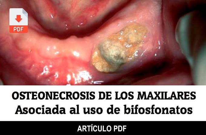 PDF: OSTEONECROSIS de los maxilares asociada al uso de bifosfonatos