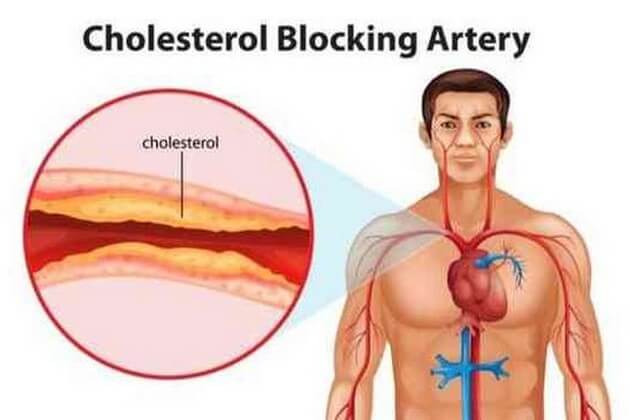 ukuran kolesterol darah yang wajib Anda ketahui