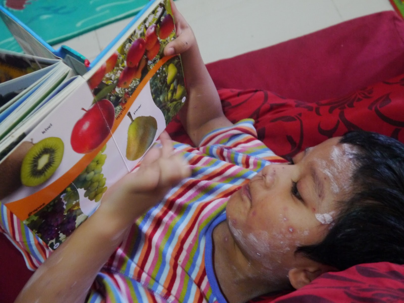 Ubat Hilangkan Parut Kudis Di Kaki - Lamaran M