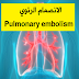 الانصمام الرئوي Pulmonary embolism (جلطة دموية في الرئتين ، احتشاء رئوي ، انسداد الشريان الرئوي)