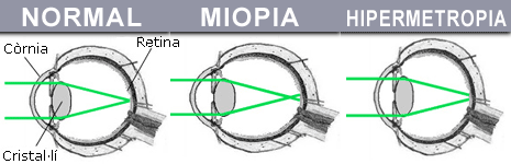 Resultado de imagen de hipermetropia imatges